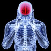 pic of cerebellum  - a man with a headache under x - JPG 