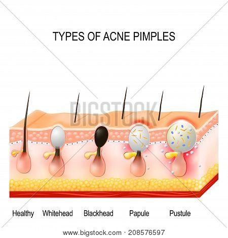 acne pustule diagram just wiring data