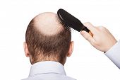 foto of mid adult  - Human alopecia or hair loss  - JPG 